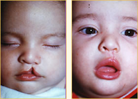 Cleft Lip Pediatric