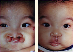 Cleft Lip Pediatric