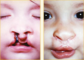 Cleft Lip Pediatric