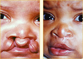 Cleft Lip Pediatric