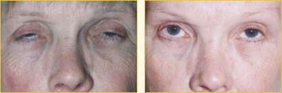 Eyelid Surgery