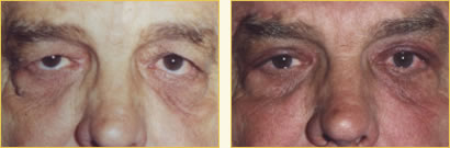 Eyelid Surgery