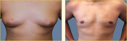Gynecomastia