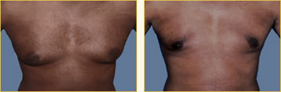 Gynecomastia