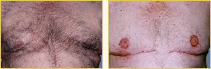 Gynecomastia