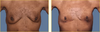 Gynecomastia