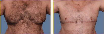 Gynecomastia