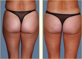 Liposuction