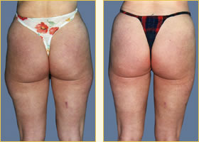 Liposuction