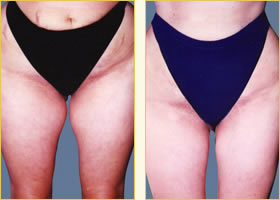 Liposuction