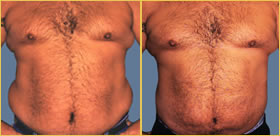 Liposuction