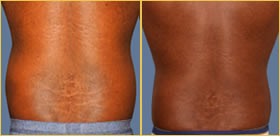 Liposuction