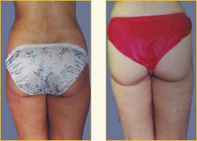 Liposuction