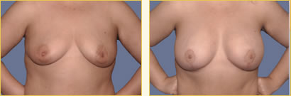 Mastopexy
