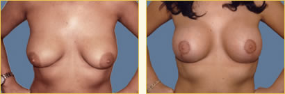 Mastopexy