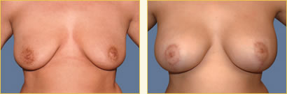 Mastopexy