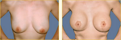 Mastopexy