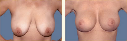 Mastopexy