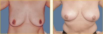 Mastopexy