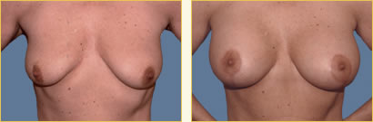 Mastopexy