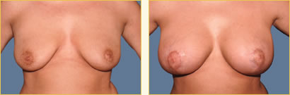 Mastopexy