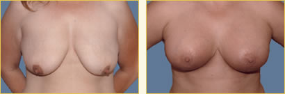 Mastopexy