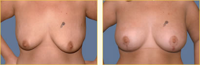 Mastopexy