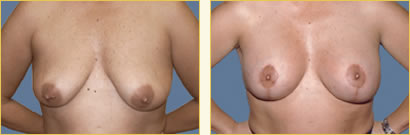Mastopexy