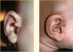Microtia Reconstruction Surgery
