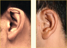 Microtia Reconstruction Surgery