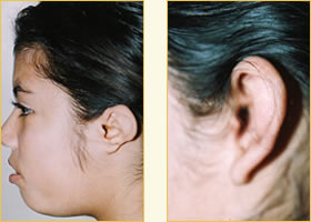 Microtia Reconstruction Surgery