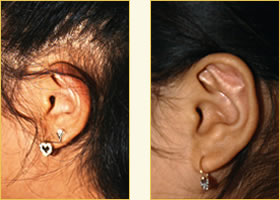 Microtia Reconstruction Surgery