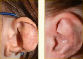 Microtia Reconstruction Surgery