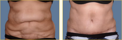 Before and After Post-Bariatric Surgery