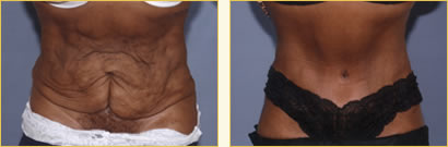 Before and After Post-Bariatric Surgery