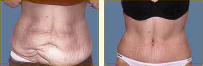 Before and After Post-Bariatric Surgery