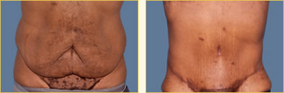 Before and After Post-Bariatric Surgery