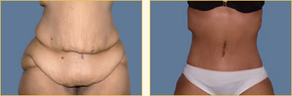 Before and After Post-Bariatric Surgery