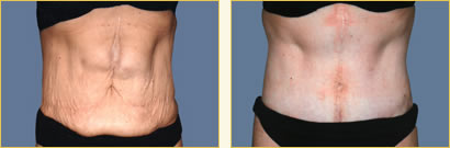 Before and After Post-Bariatric Surgery