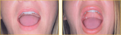 Perma Facial Implant