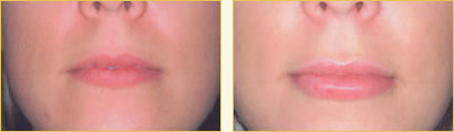 Perma Facial Implant