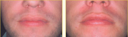 Perma Facial Implant