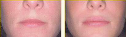 Perma Facial Implant