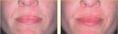 Perma Facial Implant