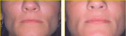 Perma Facial Implant