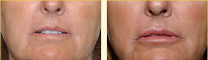 Perma Facial Implant