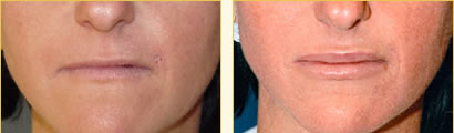 Perma Facial Implant