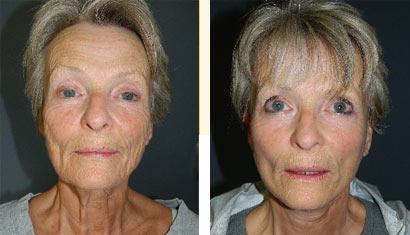 In-office-Facelift1 In-office Facelift