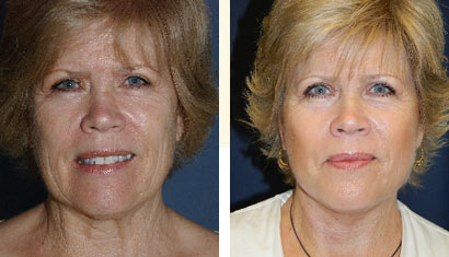 In-office-Facelift4 In-office Facelift