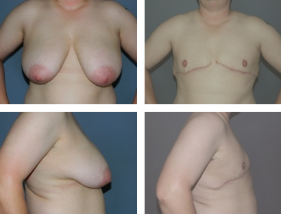 Female to Male gender reassignment surgery Female to Male Gender Re-assignment Surgery